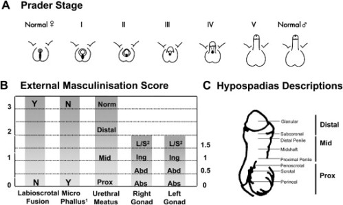 Scoring External Genitalia. A. The external genitalia can be objectively scored using the Prader staging system which provides an overall score for the appearance of the external genitalia. B. Alternatively, each individual feature of the genitalia (phallus size, labioscrotal fusion, site of the gonads and location of urethral meatus) can be individually scored to obtain the External Masculinisation Score (EMS). Adapted from Ahmed et al., BJU Int. 2000;85:120–4. (Source)